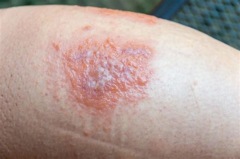 Mysterious rash - Healthy Food Near Me