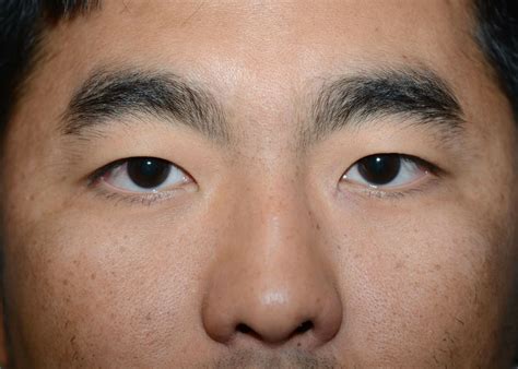 Double Eyelid #1171 - Amadi Aesthetics | Plastic Surgery & Med SPA