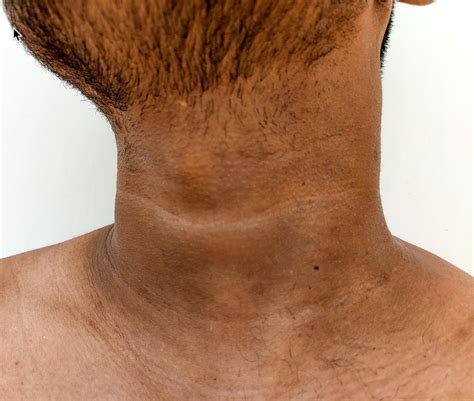 acanthosis nigricans   jzquw