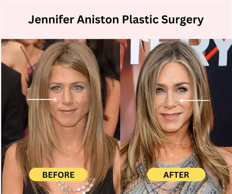 Before & After: Analyzing Jen Psaki's Possible Plastic Surgery - z7fy8yo