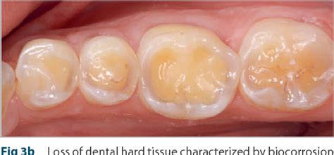 Occlusal Surface Of Tooth