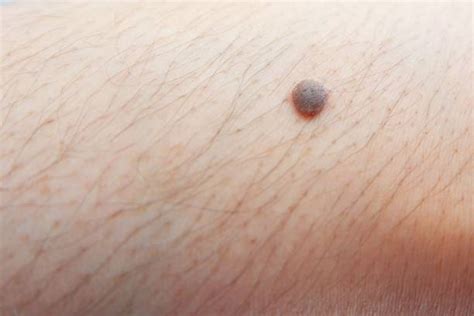 red blotches  legs stock  pictures royalty  images istock