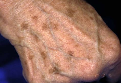 White Spots on Tan Skin: Causes and Treatments - Hunter Games Magazine