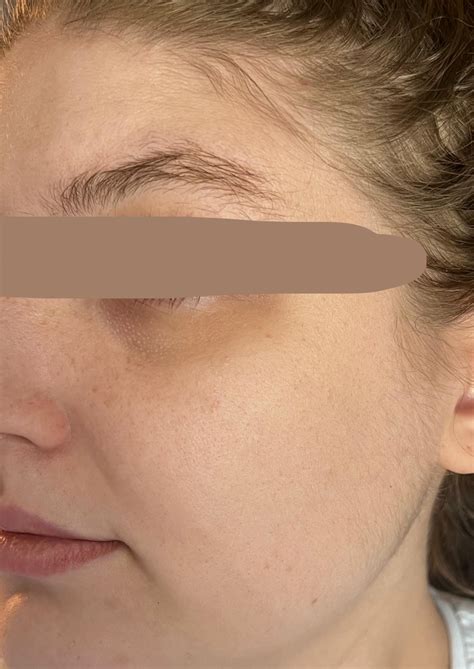 Dark circles and discoloration under eyes and cannot seem to help