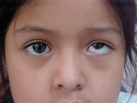 What is an oculogyric crisis? — Brain Stuff