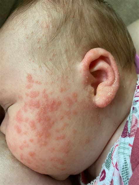 Infantile Seborrheic Dermatitis Face