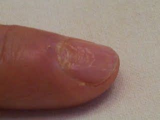Гигрома кисти