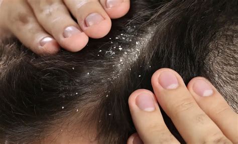 dandruff    stop  fast