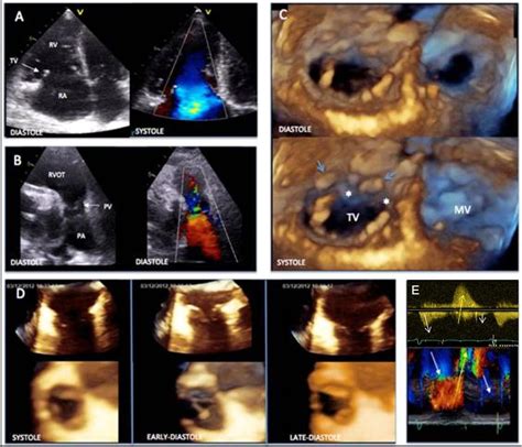 carcinoid heart disease  winking heart heart asia