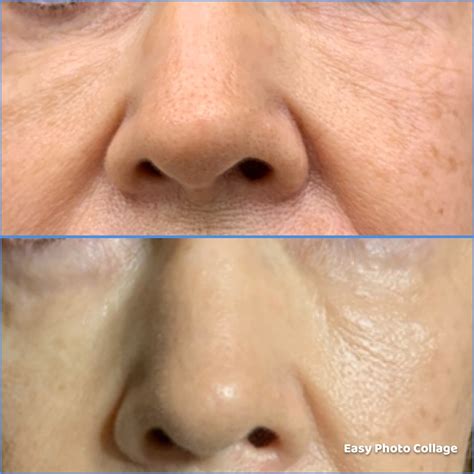 Fotona 4D Facelift - Facial Rejuvenation in Frisco, Texas