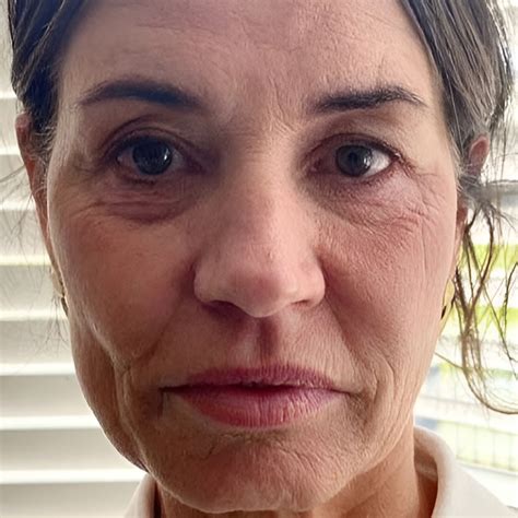 Non-Surgical Facelift | Transformation Facelift London & Cheshire | Dr