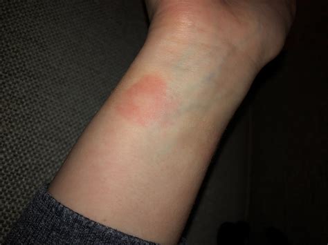 Why Do I Get A Rash After Wearing My Apple Watch ? - DeviceMAG