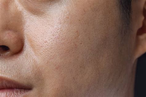 oily skin dermatologist skincare  years