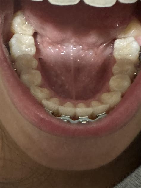 My daughter’s 2 back molars are very slanted and her braces are