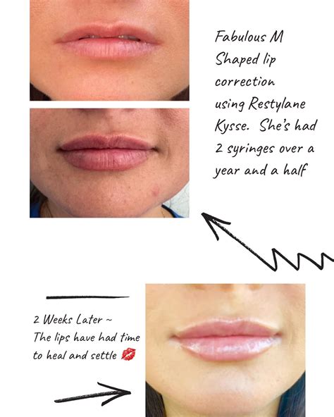 What are M Shaped lips? M shaped... - Blake Thomas, FNP-C