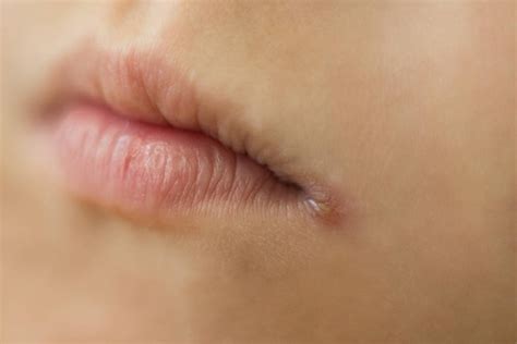 Cheilitis képek, stock fotók és fényképek a következőről: Cheilitis