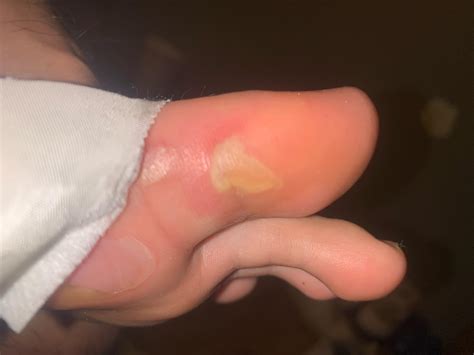 Infected blister? : r/woundcare