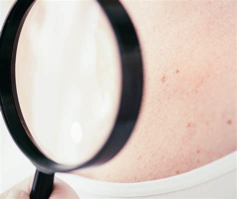 UV-Schutz gegen Hautkrebs | Leben mit Hautkrebs