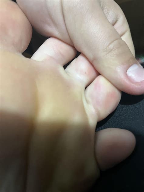 Keep getting these werid cuts on my toes : r/medical_advice