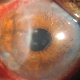 months  full thickness patch graft  scientific diagram