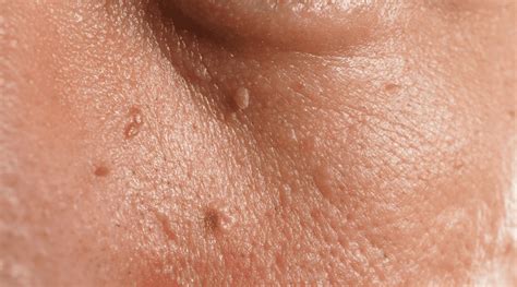 skin tags archives sba dermatology