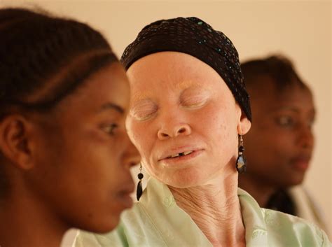 The ritual murders of albinos in parts of Africa: 6 things you need to ...