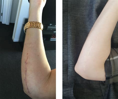 Ulnar Nerve Transposition Surgery Recovery Kat Hawtho - vrogue.co