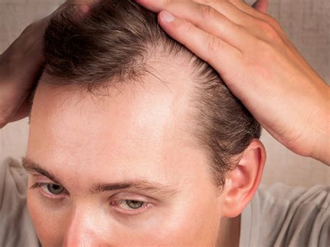 Androgenetic Alopecia in Celina, TX | Everoak Dermatology