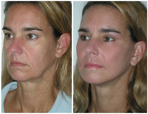 cost thread face lift 7