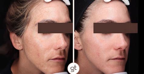 Before and After Gallery Diamond Glow Facial - Radiant Results