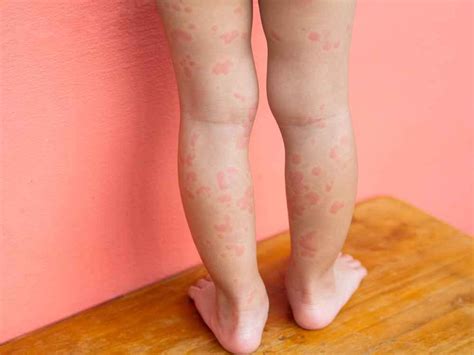 obat campak  anak  apotek ampuh atasi gejala