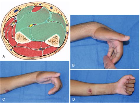 Volkmann’s Contracture | Hand Therapy Academy