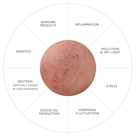 ADULT ACNE