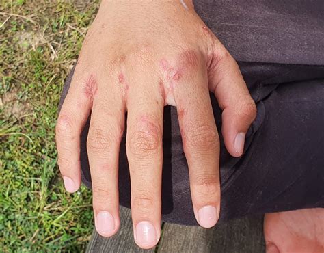 Scabies - ZOOM Pharmacy