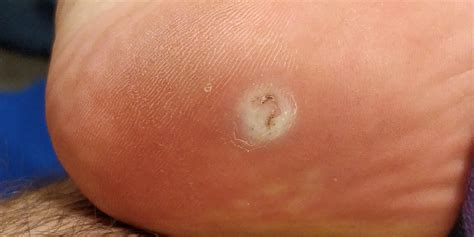 Nearly 2 months into this wart on my foot is it gone? : Warts
