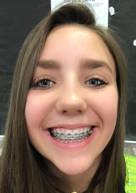 Cute Girl Braces For Teeth – Telegraph