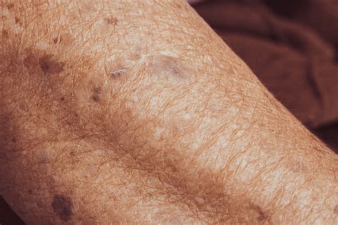 ala pdt long term effect  photoaging