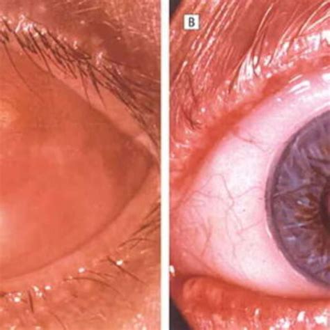 Cirurgia dente-no-olho: técnica inovadora que devolve a visão a pessoas