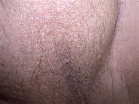 Small bumps just under base of scrotum? : r/DermatologyQuestions