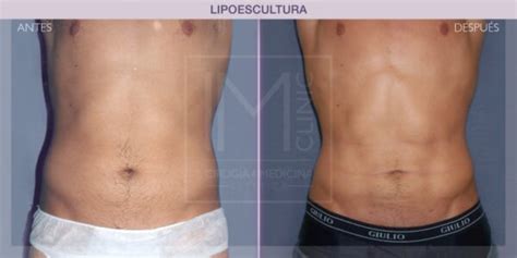 Lipoescultura Antes E Depois