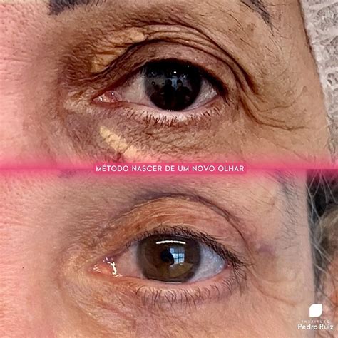 Dentista Pode Fazer Blefaroplastia