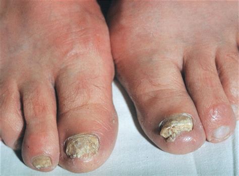 Dystrophic Nails In Es - Nail Ftempo