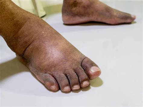 feet  man  diabetes dull  swollen due   toxicity