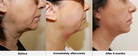 hifu-before-and-after-face-lift | Teesside HIFU non surgical face, neck and body lifts