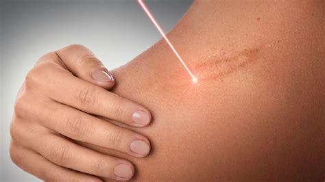 Remoção De Cicatriz A Laser Preço - Laser para Cicatrizes - Dra. Juliana Toma