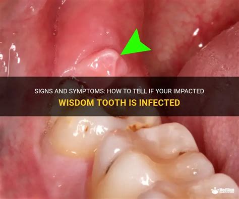 signs  symptoms      impacted wisdom tooth  infected medshun