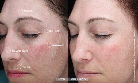 HALO Hybrid Fractional Laser Resurfacing - Dr. Beth Comeau MD