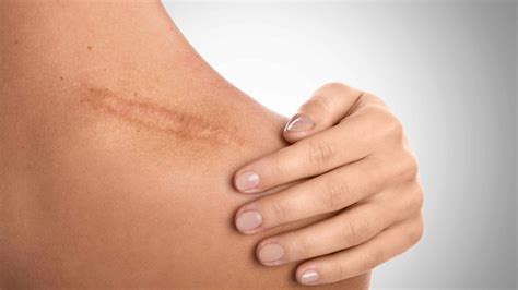 scars treatment cardiff cosmetic clinic