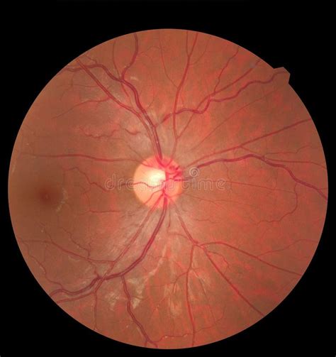 ophthalmoscope optic nerve head  rita pablo blog