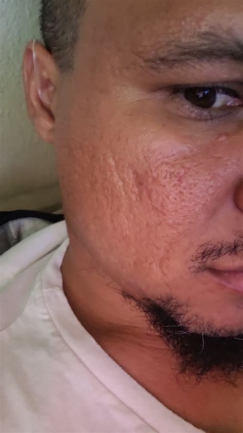 acne pock marks racnescars